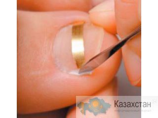 Как избавиться от вросшего ногтя в Алматы? Алматы