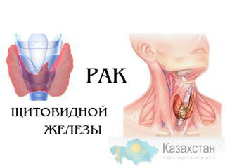 Операции опухолей щитовидной железы Другое месторасположение