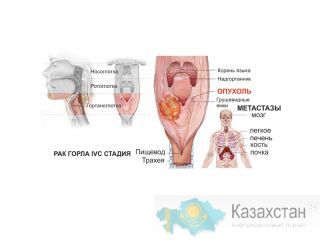 Рак горла, гортани, миндалин. Лечение. Другое месторасположение