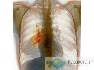 Рак легких. Лечение. Другое месторасположение