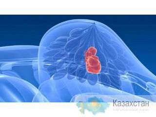 Рак молочной железы. Лечение. Другое месторасположение