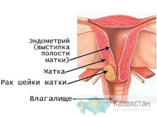 Рак шейки матки. Лечение. Другое месторасположение
