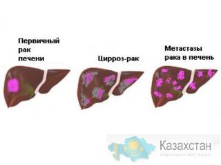 Рак печени. Лечение. Другое месторасположение