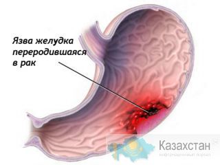 Рак желудка. Лечение. Другое месторасположение