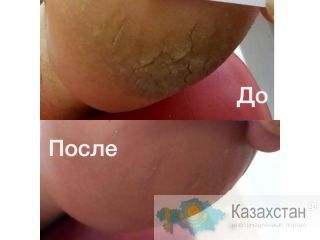 Подологический центр Карт Алматы