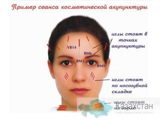 Аккурунктурная пластика лица Алматы
