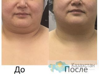 Новый 3D Smas Лифтинг, новейшая технология, впервые в Казахстане Алматы