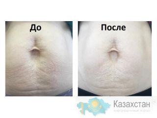 Фракционная СО2 Шлифовка Лица- 40000тг Алматы